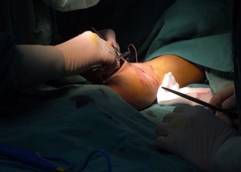 GB: un chirurgien grave ses initiales sur le foie des patients